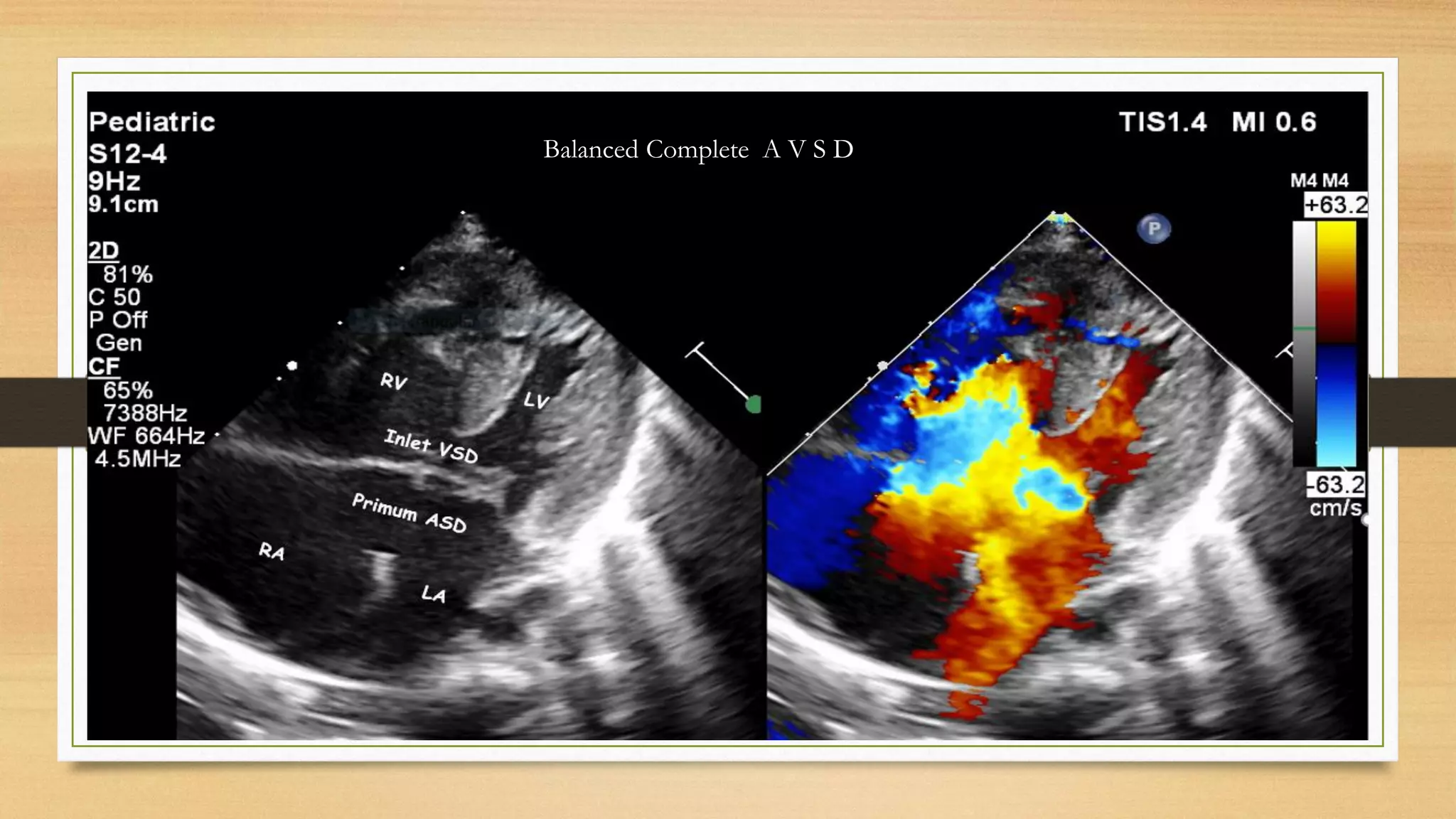 Balanced Complete A V S D
 