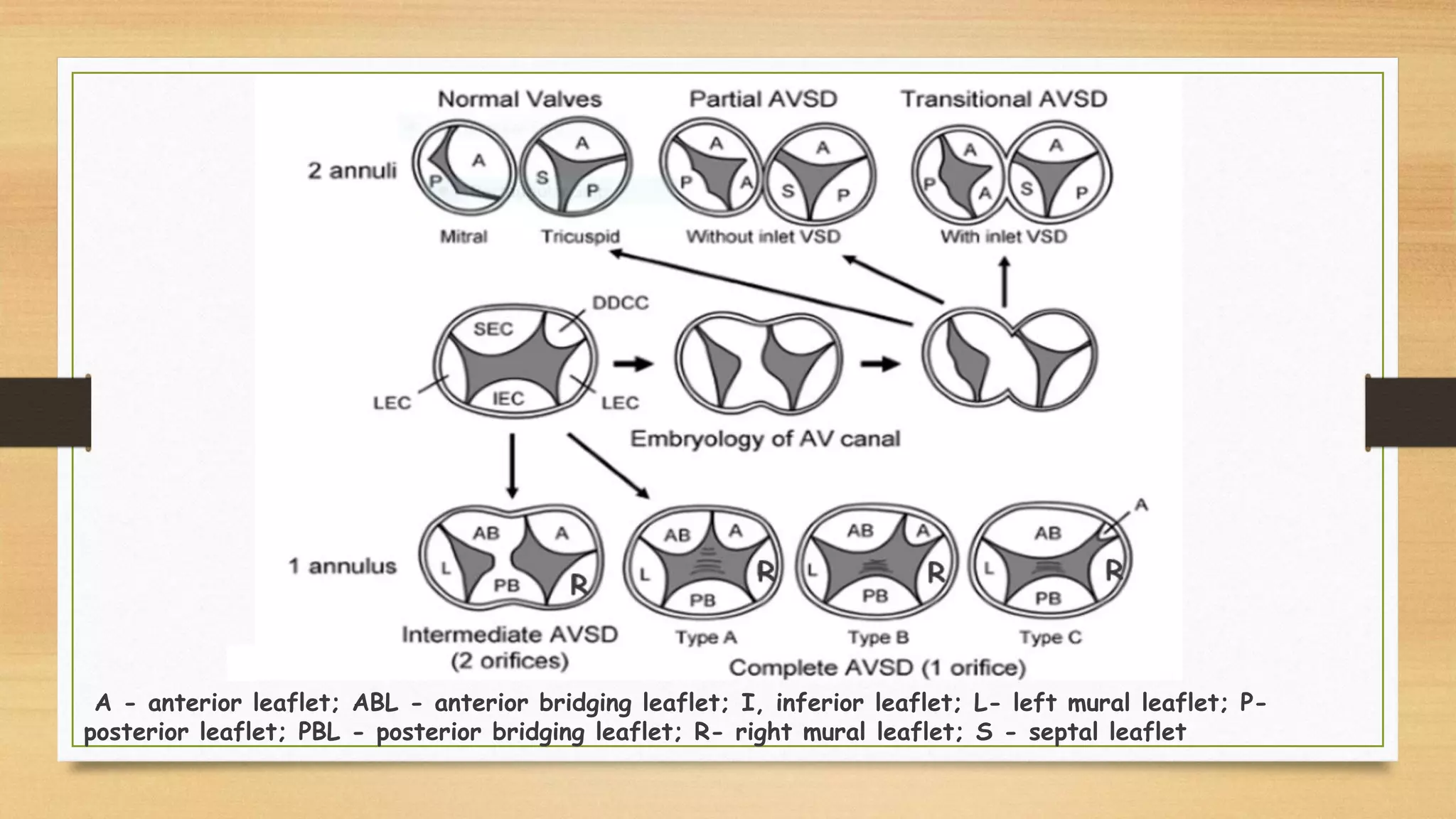 A - anterior leaflet; ABL - anterior bridging leaflet; I, inferior leaflet; L- left mural leaflet; P-
posterior leaflet; PBL - posterior bridging leaflet; R- right mural leaflet; S - septal leaflet
R
R R
R
 