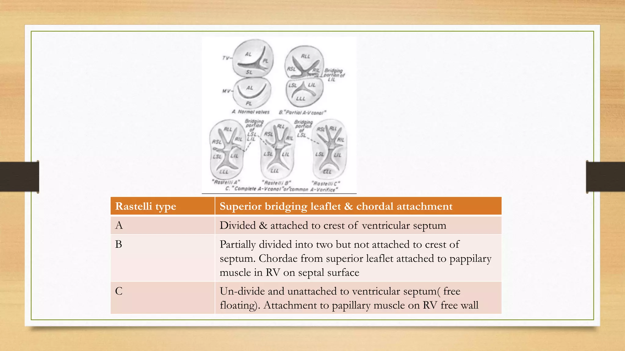 Rastelli type Superior bridging leaflet & chordal attachment
A Divided & attached to crest of ventricular septum
B Partially divided into two but not attached to crest of
septum. Chordae from superior leaflet attached to pappilary
muscle in RV on septal surface
C Un-divide and unattached to ventricular septum( free
floating). Attachment to papillary muscle on RV free wall
 