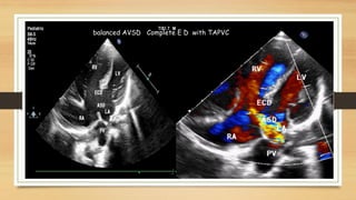 2nd Step : Try and find out associated cardiac anomaly -
TOF
DORV
Right Aortic Arch
Other cono-truncal anomalies
Pul. atre...