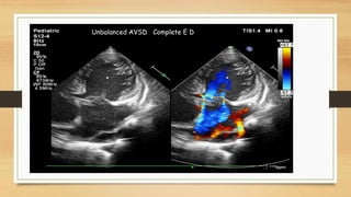 AVSD
isolated Complex AVSD
Does Fetus with AVSD need Genetic testing ?
AVSD is associated with Genetic disorders -
21 tris...