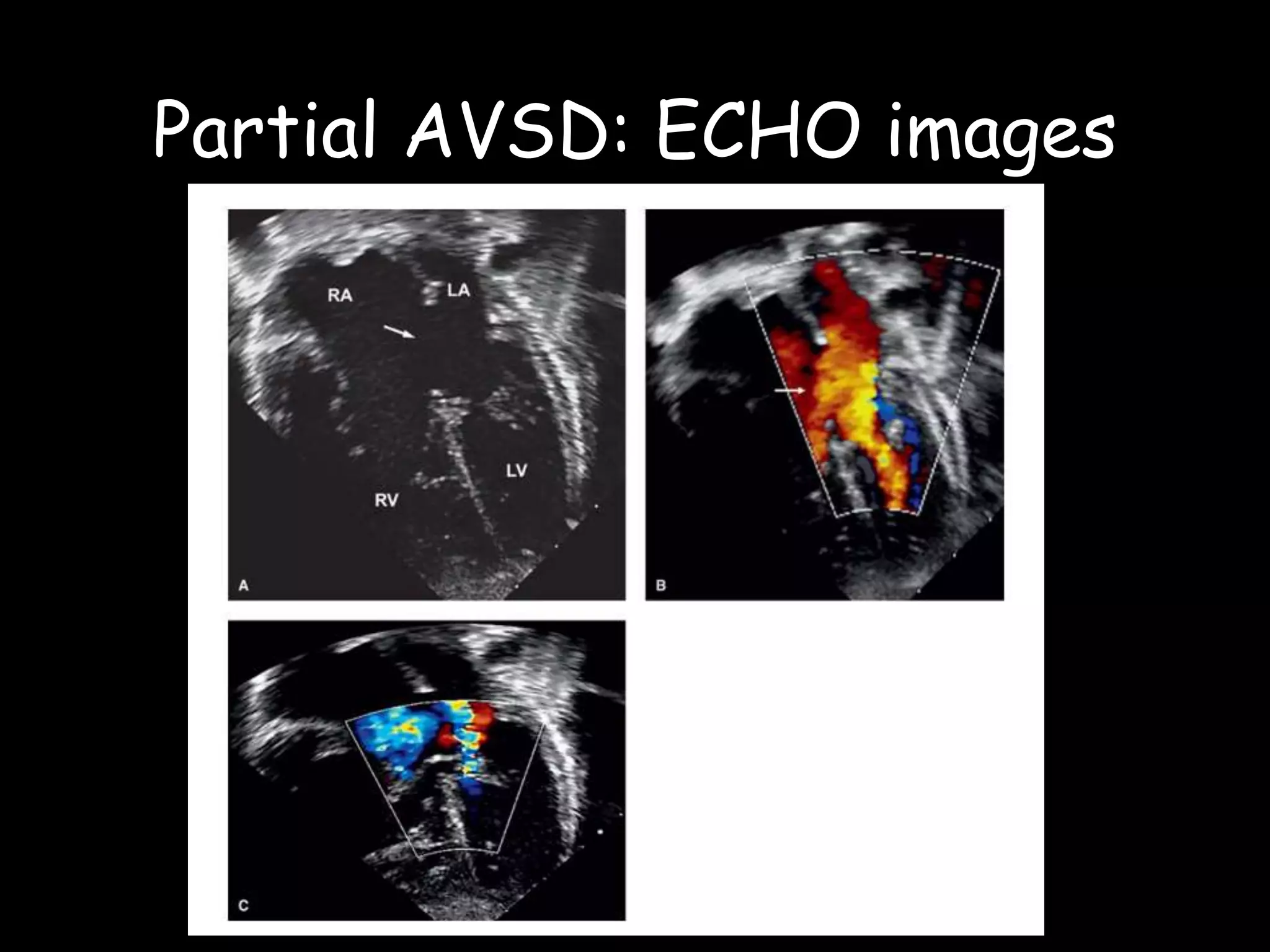 ATRIOVENTRICULAR SEPTAL DEFECT | PPTX