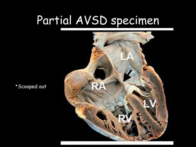 ATRIOVENTRICULAR SEPTAL DEFECT | PPTX | Heart and Cardiovascular ...