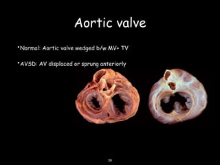 ATRIOVENTRICULAR SEPTAL DEFECT | PPTX