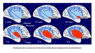Évolution de la zone de la nécrose cérébrale en absence de recanalisation
 