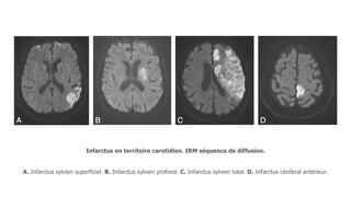Infarctus en territoire carotidien. IRM séquence de diffusion.
A. Infarctus sylvien superficiel. B. Infarctus sylvien profond. C. Infarctus sylvien total. D. Infarctus cérébral antérieur.
 