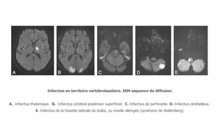 Infarctus en territoire vertébrobasilaire. IRM séquence de diffusion.
A. Infarctus thalamique. B. Infarctus cérébral postérieur superficiel. C. Infarctus de perforante. D. Infarctus cérébelleux.
E. Infarctus de la fossette latérale du bulbe, ou moelle allongée (syndrome de Wallenberg).
 