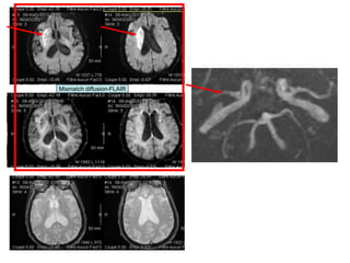 Mismatch diffusion-FLAIR
 
