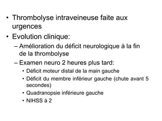 • Thrombolyse intraveineuse faite aux
urgences
• Evolution clinique:
– Amélioration du déficit neurologique à la fin
de la thrombolyse
– Examen neuro 2 heures plus tard:
• Déficit moteur distal de la main gauche
• Déficit du membre inférieur gauche (chute avant 5
secondes)
• Quadranopsie inférieure gauche
• NIHSS à 2
 