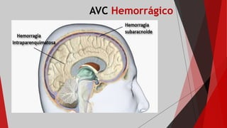 AVC Hemorrágico
 