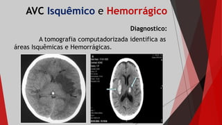 AVC Isquêmico e Hemorrágico
Diagnostico:
A tomografia computadorizada identifica as
áreas Isquêmicas e Hemorrágicas.
 