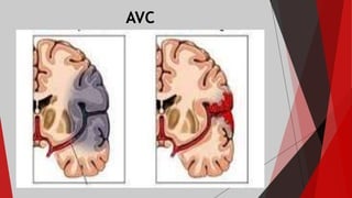 AVC
 