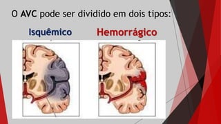 O AVC pode ser dividido em dois tipos:
Isquêmico Hemorrágico
 