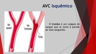 AVC Isquêmico
O trombo é um coágulo de
sangue que se junta à parede
do vaso sanguíneo.
 