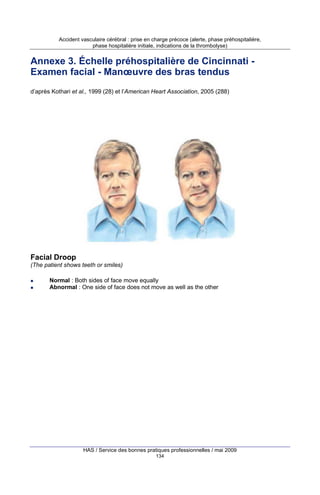 Accident vasculaire cérébral : prise en charge précoce (alerte, phase préhospitalière,
phase hospitalière initiale, indications de la thrombolyse)

Annexe 3. Échelle préhospitalière de Cincinnati Examen facial - Manœuvre des bras tendus
d’après Kothari et al., 1999 (28) et l’American Heart Association, 2005 (288)

Facial Droop
(The patient shows teeth or smiles)
Normal : Both sides of face move equally
Abnormal : One side of face does not move as well as the other

HAS / Service des bonnes pratiques professionnelles / mai 2009
134

 