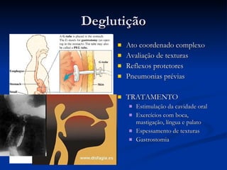 Deglutição Ato coordenado complexo Avaliação de texturas Reflexos protetores Pneumonias prévias TRATAMENTO Estimulação da cavidade oral Exercícios com boca, mastigação, língua e palato Espessamento de texturas Gastrostomia 
