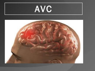AVC 