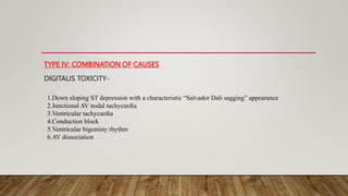TYPE IV: COMBINATION OF CAUSES
DIGITALIS TOXICITY-
1.Down sloping ST depression with a characteristic “Salvador Dali sagging” appearance
2.Junctional AV nodal tachycardia
3.Ventricular tachycardia
4.Conduction block
5.Ventricular bigeminy rhythm
6.AV dissociation
 