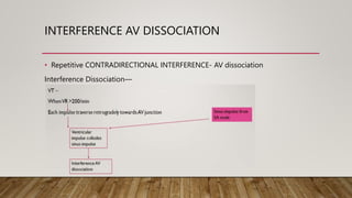 INTERFERENCE AV DISSOCIATION
• Repetitive CONTRADIRECTIONAL INTERFERENCE- AV dissociation
Interference Dissociation—
 