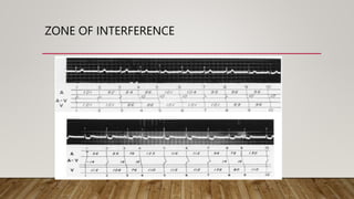 ZONE OF INTERFERENCE
 