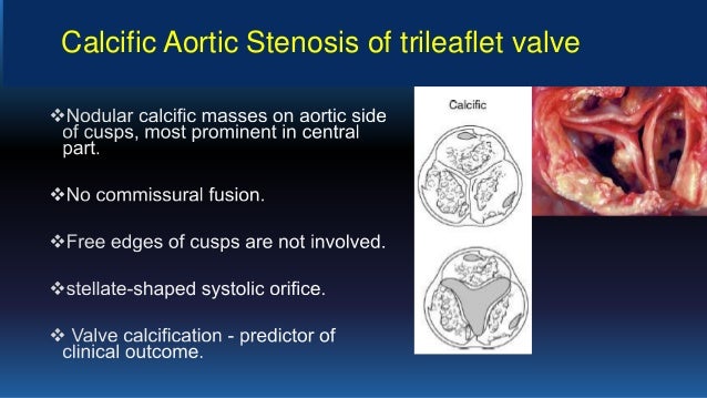Aortic valve sclerosis treatment
