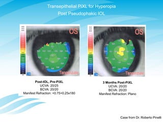 Transepithelial PiXL for Hyperopia
Post Pseudophakic IOL
Post-IOL, Pre-PiXL
UCVA: 20/25
BCVA: 20/20
Manifest Refraction: +0.75+0.25x180
3 Months Post-PiXL
UCVA: 20/20
BCVA: 20/20
Manifest Refraction: Plano
Case from Dr. Roberto Pinelli
 
