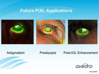 Future PiXL Applications
Presbyopia Post-IOL EnhancementAstigmatism
MA-00569A
 