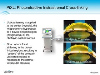 PiXL: Photorefractive Instrastromal Cross-linking
• UVA patterning is applied
to the center (myopia), the
midperiphery (hyperopia),
or a bowtie shaped region
(astigmatism) of the
riboflavin-soaked cornea
• Goal: induce focal
stiffening in the cross-
linked regions, resulting in
“bulging” of the cornea in
untreated regions in
response to the normal
intraocular pressure
Myopia Treatment
Hyperopia Treatment
MA-00569A
 