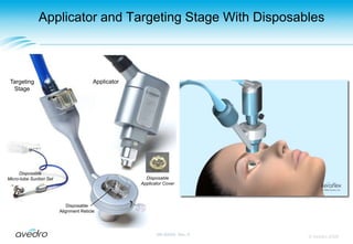 Alteration of the collagen in the periphery applies stress to the central cornea, causing flattening and the reduction of myopia.© Avedro 2009MA-00005, Rev. A