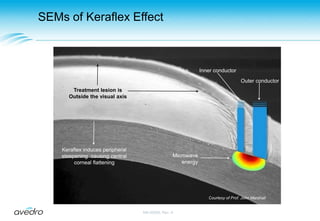 Applicator and Targeting Stage With DisposablesApplicatorTargeting StageDisposable Micro-tube Suction SetDisposable Applicator CoverDisposable Alignment Reticle© Avedro 2009MA-00005, Rev. A