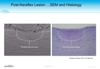 Cross-Sectional ViewApplicatorEnd ViewInner conductorOuter conductorInner conductorOuter conductorGapspacingMicrowaveenergyGapspacingCorneaKeraflex Applicator Design© Avedro 2009MA-00005, Rev. A