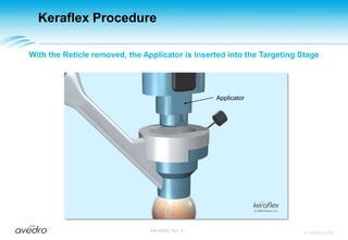 Keraflex ProcedureOnce the patient’s prescription is entered, the Targeting Stage is     centered on the pre-marked corneal apex and the vacuum is engaged© Avedro 2009MA-00005, Rev. A