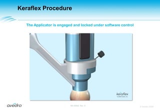 Keraflex ProcedureWith vacuum applied to the Targeting Stage, the Alignment Reticle is placed into the Targeting Stage and finely aligned to the corneal apex; once the Reticle is aligned to the apex, the Targeting Stage is locked  Microscope view of the Reticle within the Targeting Stage and in position over the pre-marked corneal apex Knob motions to align Targeting Stage to apex: (Top) rotate for up-down alignment(Bottom) move up-down for side-to-side alignment© Avedro 2009MA-00005, Rev. A