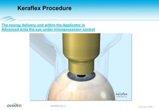 Keraflex ProcedureWith the Reticle removed, the Applicator is inserted into the Targeting StageApplicator© Avedro 2009MA-00005, Rev. A
