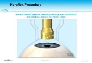 Keraflex ProcedureThe Applicator is engaged and locked under software control© Avedro 2009MA-00005, Rev. A