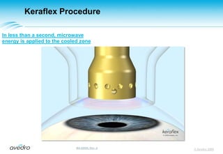 Keraflex ProcedureInternal control systems determine when proper mechanicaland electrical contact have been made© Avedro 2009MA-00005, Rev. A