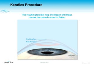 Keraflex ProcedureOnce the footswitch is depressed, micro-pulses of coolant are dispersed onto the eye providing thermal protection To the outer layer of the cornea© Avedro 2009MA-00005, Rev. A