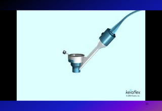 Keraflex ProcedureIn less than a second, microwave                                                                                     energy is applied to the cooled zone© Avedro 2009MA-00005, Rev. A