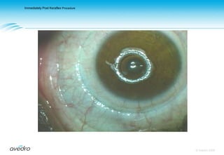 Keraflex ProcedureThe resulting toroidal ring of collagen shrinkage                                                                 causes the central cornea to flatten© Avedro 2009MA-00005, Rev. A