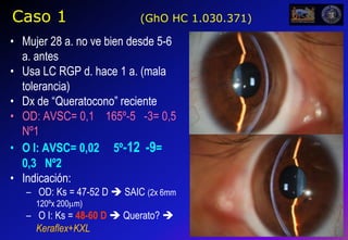 Uniformity is Key to Consistent Cross-linkingPredictability3 mW/cm2 typicalUVA light in current use30 mW/cm2KXLSystem9 mm ApertureBowman’sCenter to edge beam uniformity insures consistent resultsCool edges provide no cross-linkingEndotheliumMA-00057, Rev. A