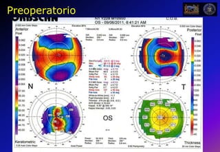 Beam Profiles for KXL and UV-X Light SourcesPredictability+5mm Out of PlaneAt Focus-5mm Out of PlaneAvedro KXLUV-XMA-00057, Rev. A