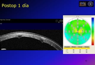 38 Caso 1             (GhO HC 1.030.371)Mujer 28 a. no ve bien desde 5-6 a. antesUsa LC RGP d. hace 1 a. (mala tolerancia)Dx de “Queratocono” recienteOD: AVSC= 0,1    165º-5   -3= 0,5    Nº1O I: AVSC= 0,02     5º-12-9= 0,3   Nº2Indicación:OD: Ks = 47-52 D  SAIC (2x 6mm 120ºx 200mm) O I: Ks = 48-60 D Querato?  Keraflex+KXL