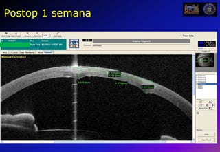 40PreoperatorioCRx: Keraflex -5 D + KXL 30mW x 3 min