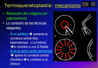 6Termoqueratoplastia: mecanismoRetracción del colágeno por calentamientoLo contrario de las técnicas relajantes:Si en periferia  aumenta la curvatura central (ttos. hipermetropía   x Ls.Holmio)        lo contrario a una Q.RadialSi en el centro (anillo pericentral)  aplana la curvatura central (Keraflex) lo contrario a un Intracor