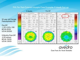 PiXL For Post-Cataract Myopia Case Example: 9 Month Post-op
9 Months Pre-OP
Case from: Dr. Pavel Stodulka
52 year old Female
Pseudophakia OD
Pre-OP:
-1.25 -0.25 x 180
BCVA 20/20
UCVA 20/200
9 Months Post-OP:
-0.50 sphere
BCVA: 20/20
UCVA: 20/25
 