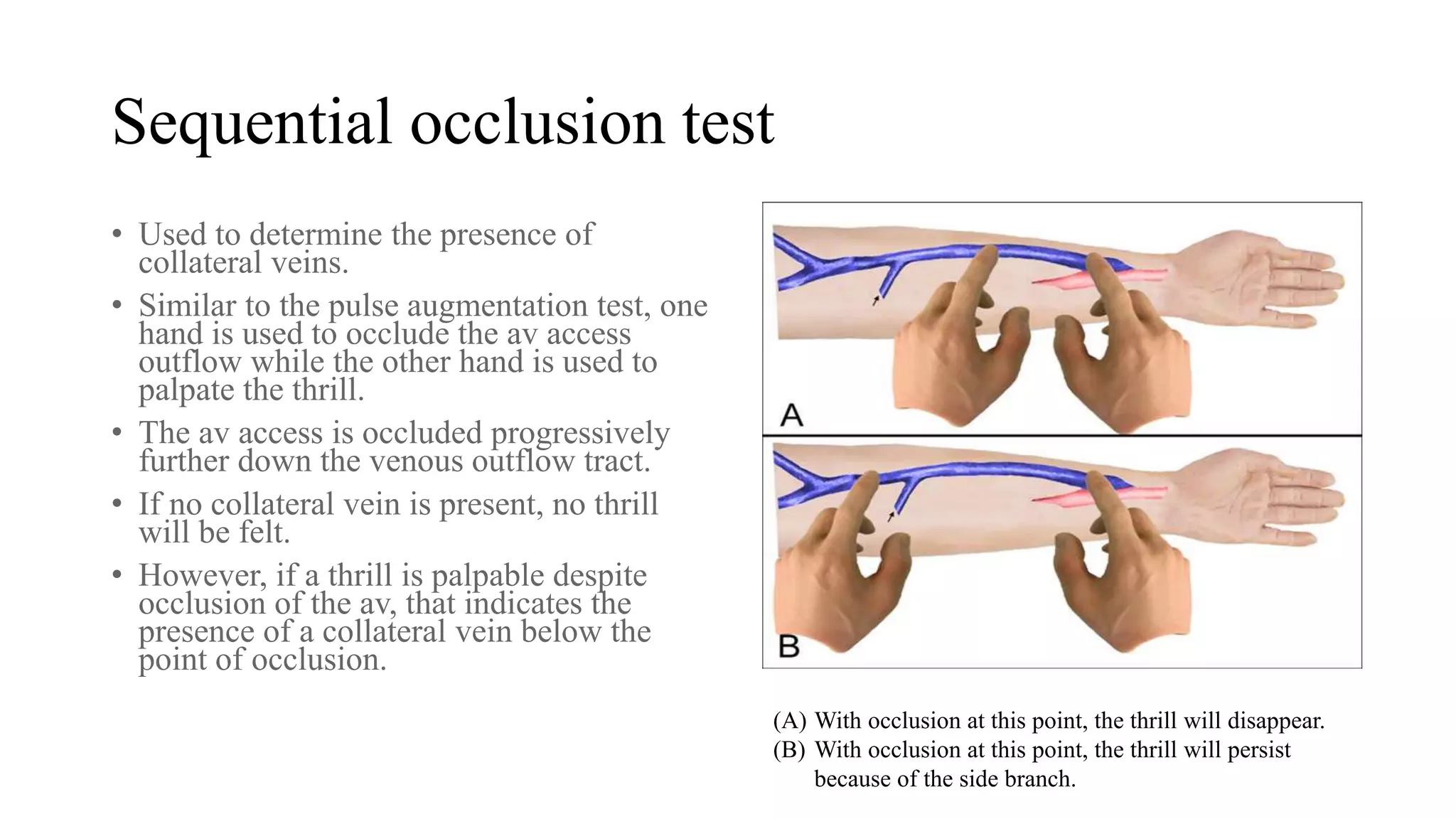 Sequential occlusion test
• Used to determine the presence of
collateral veins.
• Similar to the pulse augmentation test, one
hand is used to occlude the av access
outflow while the other hand is used to
palpate the thrill.
• The av access is occluded progressively
further down the venous outflow tract.
• If no collateral vein is present, no thrill
will be felt.
• However, if a thrill is palpable despite
occlusion of the av, that indicates the
presence of a collateral vein below the
point of occlusion.
(A) With occlusion at this point, the thrill will disappear.
(B) With occlusion at this point, the thrill will persist
because of the side branch.
 