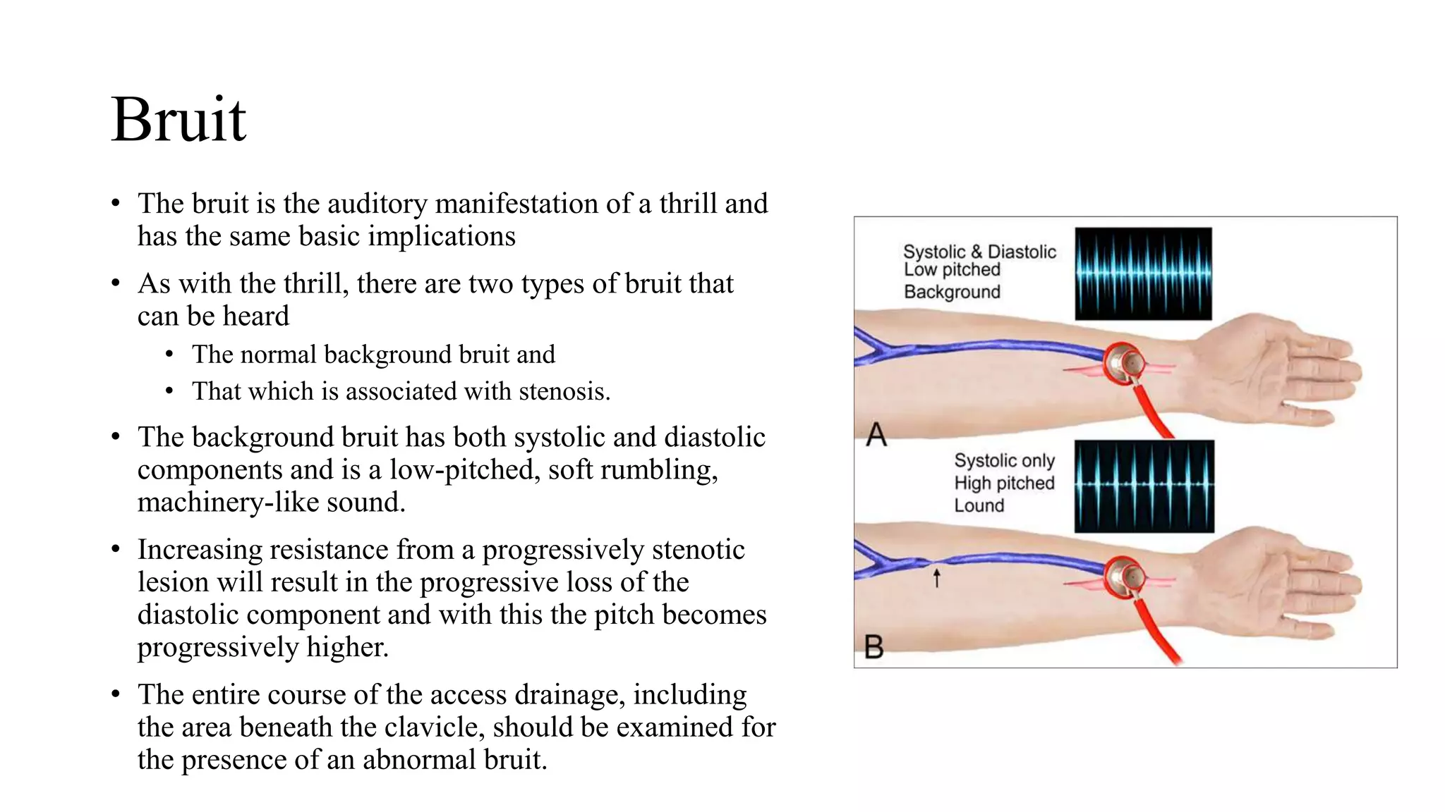 Bruit
• The bruit is the auditory manifestation of a thrill and
has the same basic implications
• As with the thrill, there are two types of bruit that
can be heard
• The normal background bruit and
• That which is associated with stenosis.
• The background bruit has both systolic and diastolic
components and is a low-pitched, soft rumbling,
machinery-like sound.
• Increasing resistance from a progressively stenotic
lesion will result in the progressive loss of the
diastolic component and with this the pitch becomes
progressively higher.
• The entire course of the access drainage, including
the area beneath the clavicle, should be examined for
the presence of an abnormal bruit.
 