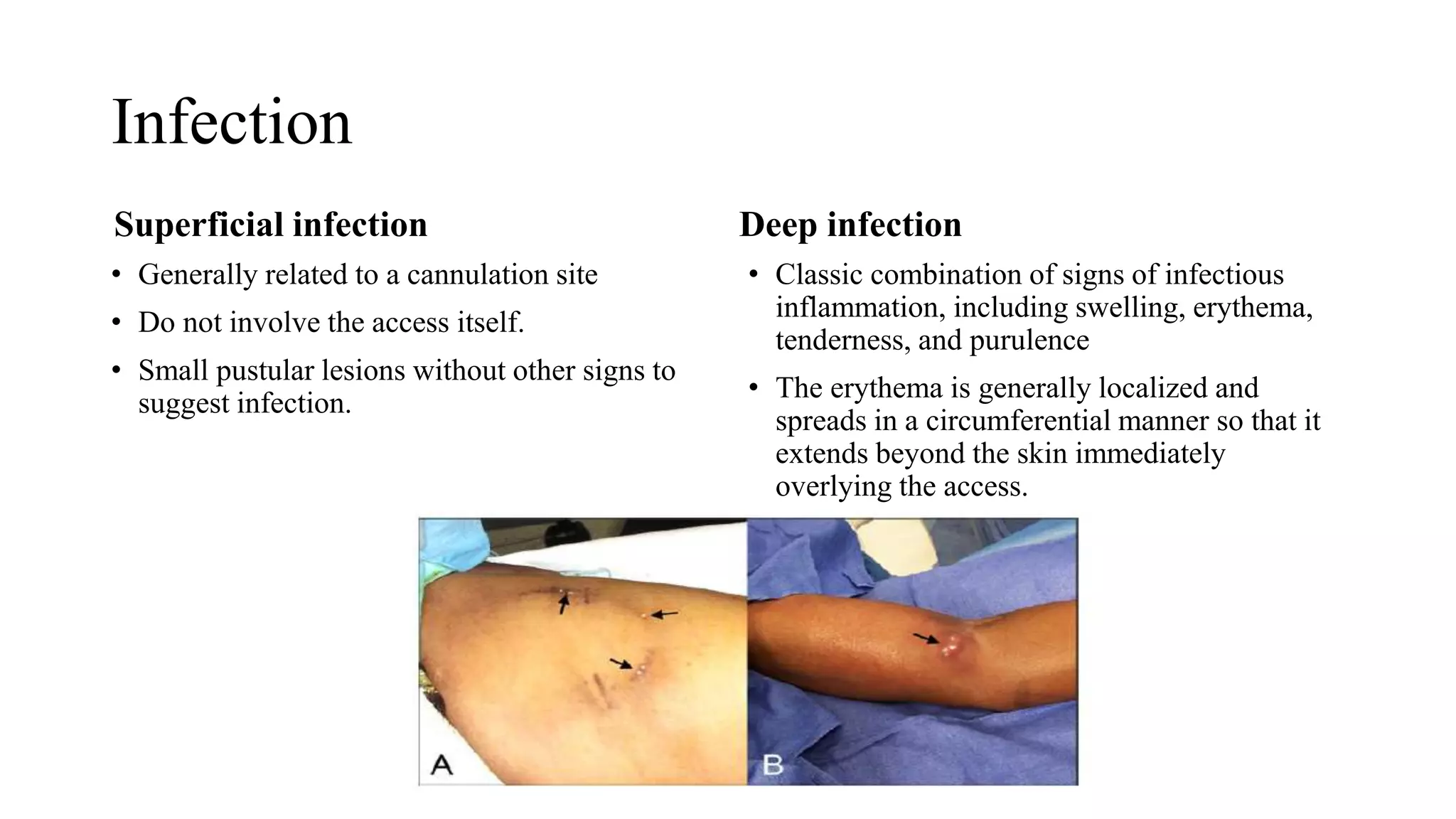 Infection
Superficial infection
• Generally related to a cannulation site
• Do not involve the access itself.
• Small pustular lesions without other signs to
suggest infection.
Deep infection
• Classic combination of signs of infectious
inflammation, including swelling, erythema,
tenderness, and purulence
• The erythema is generally localized and
spreads in a circumferential manner so that it
extends beyond the skin immediately
overlying the access.
 