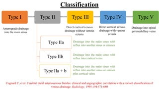Cognard Classification Rupture Risk AV fistula.pptx