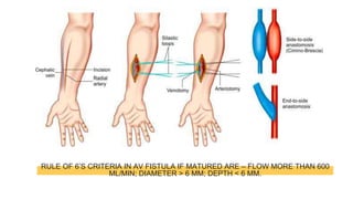 RULE OF 6’S CRITERIA IN AV FISTULA IF MATURED ARE – FLOW MORE THAN 600
ML/MIN; DIAMETER > 6 MM; DEPTH < 6 MM.
 